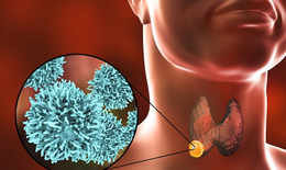 Giải pháp hỗ trợ giảm sự phát triển u tuyến giáp lành tính