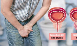 3 điều cần biết về bệnh ph&#236; đại tuyến tiền liệt