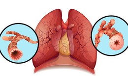 6 c&#226;u hỏi thường gặp về bệnh gi&#227;n phế quản