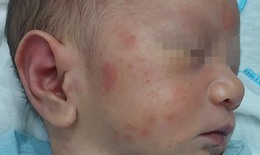 Da khô ngứa khi thời tiết lạnh, cẩn thận với viêm da cơ địa