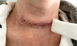 C&#225;ch chăm s&#243;c vết mổ cho bệnh nh&#226;n tuyến gi&#225;p