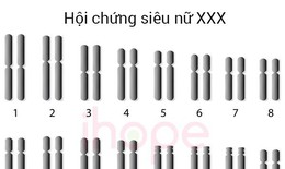 Tập vật l&#253; trị liệu cho người mắc hội chứng si&#234;u nữ