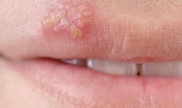 C&#225;ch ph&#242;ng tr&#225;nh l&#226;y nhiễm Herpes sinh dục