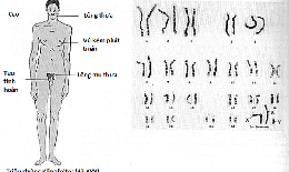Hội chứng XYY có chữa được không?