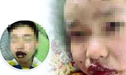Trẻ bị tổn thương da nặng do dị ứng chậm