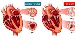 Nhận biết và phòng bệnh van hai lá