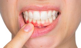 Viêm lợi nên kiêng ăn gì?