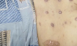 Người loang lổ sẹo do đốt thuốc của ‘lang vườn’ trị đau lưng