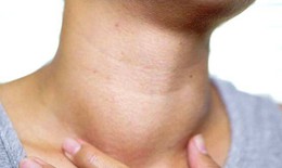 Thuốc điều trị lao hạch