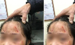 Vụ nữ sinh lớp 6 ở Hà Nội bị bạn đánh chảy máu mặt: UBND quận yêu cầu xác minh
