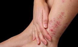 Viêm da cơ địa có nguy hiểm không?