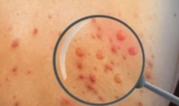 C&#224; Mau x&#225;c nhận c&#243; ca bệnh đậu m&#249;a khỉ