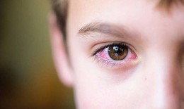 Viêm kết mạc mùa xuân có lây không?