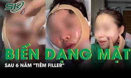 Nữ TikToker bị biến dạng mặt sau 6 năm tiêm filler