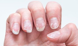 6 dấu hiệu trên móng tay cảnh báo vấn đề sức khỏe nghiêm trọng