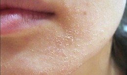 L&#224;m g&#236; khi da bị kh&#244;, ngứa, nứt nẻ?