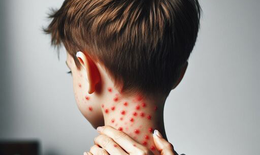 Chế độ ăn cho người bệnh Rubella