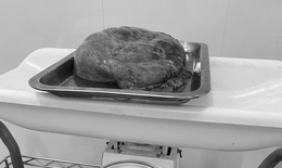 Thành công cắt bỏ khối u buồng trứng nặng 2 kg và ruột thừa viêm cấp