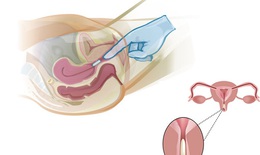 Biện ph&#225;p điều trị nấm Candida &#226;m đạo