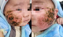 Tự đắp lá cây chữa viêm da, bé trai 4 tháng tuổi bị loét má