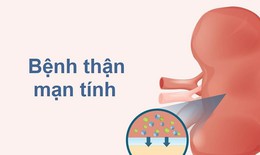 4 cách ngăn chặn bệnh thận mạn tiến triển thành suy thận