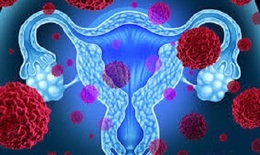 7 biểu hiện sớm của ung thư buồng trứng ở phụ nữ