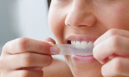 Có nên tự tẩy trắng răng tại nhà?