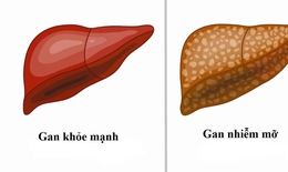 Gan nhiễm mỡ: Nguyên nhân, biểu hiện, điều trị và phòng bệnh