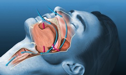 Ngừng thở khi ngủ: Nguy&#234;n nh&#226;n, biểu hiện, điều trị v&#224; ph&#242;ng bệnh