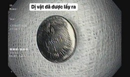 Hải Phòng: Bé 5 tuổi nuốt phải pin cúc