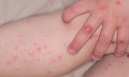 Sở Y tế Hà Nội cảnh báo cao điểm dịch tay chân miệng
