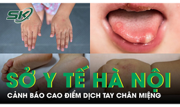 Sở Y tế H&#224; Nội cảnh b&#225;o số ca mắc tay ch&#226;n miệng tăng mạnh