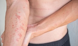 Thời tiết nắng nóng người mắc viêm da cơ địa cần lưu ý gì?