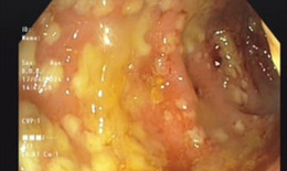 Tự ý dùng thuốc kháng sinh để chữa bệnh, cụ bà 81 tuổi bị viêm đại tràng