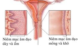 Mệt mỏi, lo lắng, căng thẳng cũng g&#226;y kh&#244;, teo &#226;m đạo v&#224; c&#225;ch cải thiện