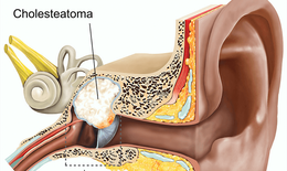 Bệnh Cholesteatoma bẩm sinh tai giữa v&#224; c&#225;ch điều trị
