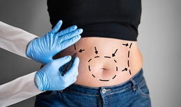 Những ai không nên hút mỡ bụng?