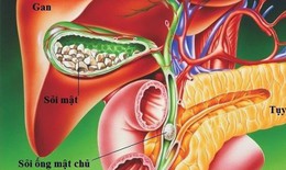 Sỏi túi mật có phải phẫu thuật không?