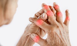 V&#236; sao cần bổ sung vitamin D khi bị vi&#234;m khớp dạng thấp?