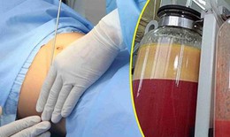 Lợi và hại của các phương pháp hút mỡ