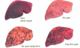 C&#225;c dấu hiệu cảnh b&#225;o ung thư gan