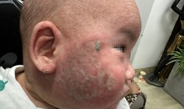 Chữa viêm da cơ địa bằng tắm lá, bé 5 tháng tuổi phải nhập viện