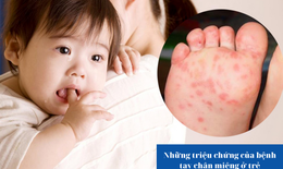 Những triệu chứng của bệnh tay chân miệng ở trẻ