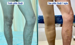 Tĩnh mạch chi dưới có thể gây ra những biến chứng nguy hiểm gì?