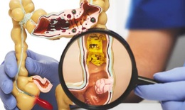 4 điều cần biết khi khám sàng lọc ung thư đại trực tràng