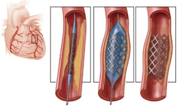 4 điều cần ch&#250; &#253; sau khi đặt stent động mạch v&#224;nh