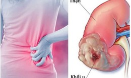 Ung thư thận có biểu hiện gì, điều trị thế nào?