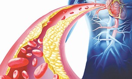 3 lý do khiến người cao tuổi dễ bị mỡ máu cao và cách khắc phục
