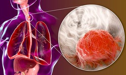Chế độ ăn cho bệnh nh&#226;n ung thư thực quản