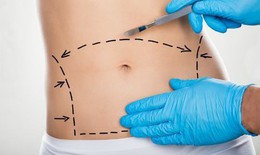 Được và mất khi phẫu thuật tạo hình thành bụng